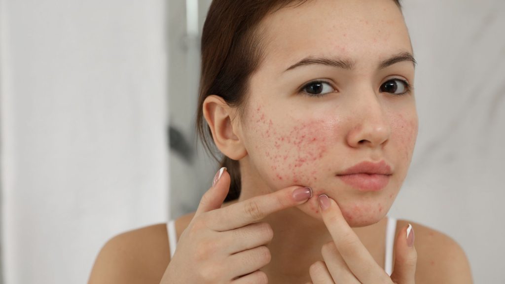 Bakuchiol For Acne Scars